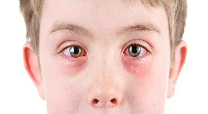Conjunctivitis Symptoms and Signs