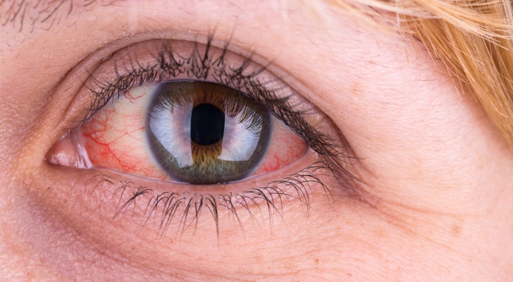 Glaucoma Symptoms and Signs