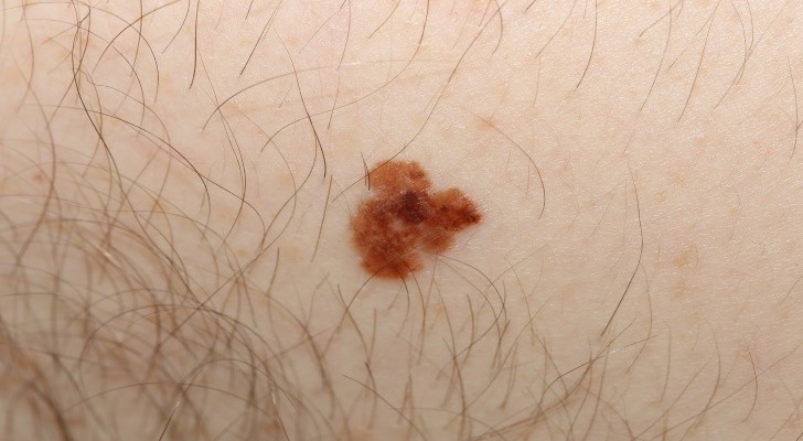 Melanoma, Skin Cancer Symptoms and Signs