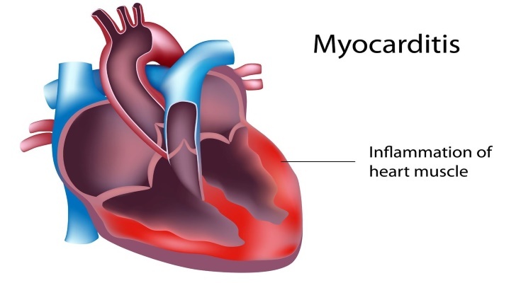 Myocarditis Symptoms, Causes and Treatement