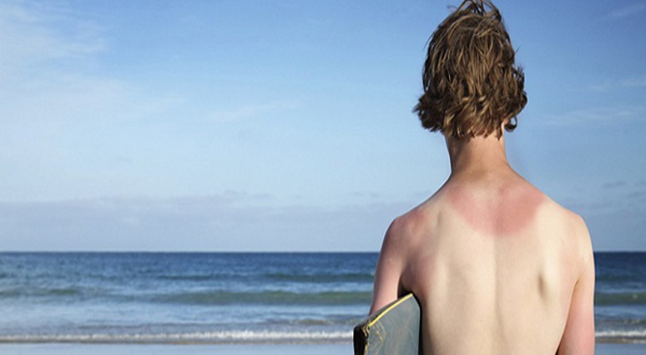 Sunburn Causes, Types, Symptoms and Remedies