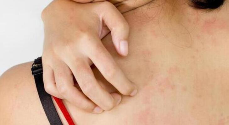 Scabies Symptoms, Causes and Treatments