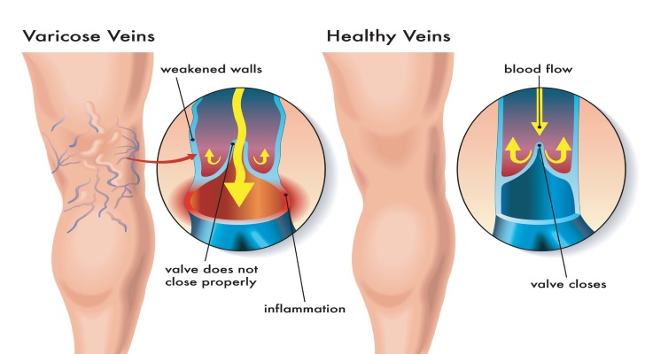 Varicose Veins Symptoms, Causes and Diagnostics