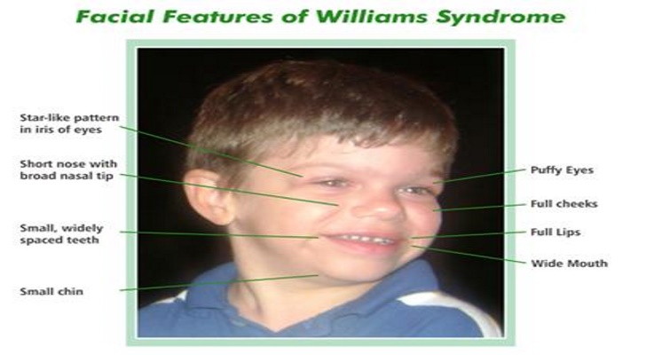 Williams Syndrome Symptoms, Diagnosis and Treatment