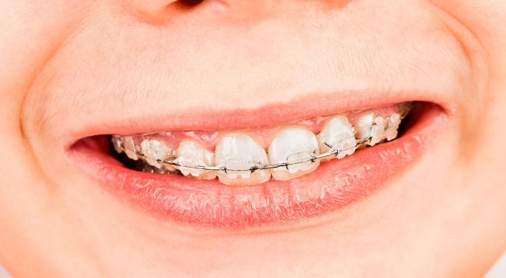 Affordable Dental Braces. How Much Do Braces Cost?
