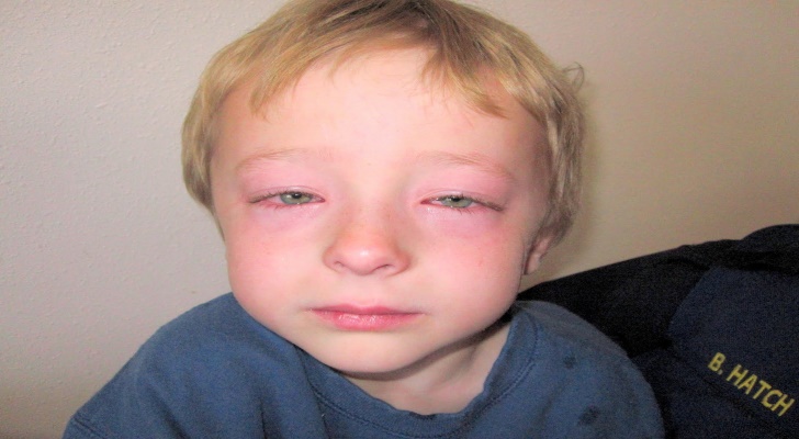 Angioedema Symptoms, Causes and Diagnosis