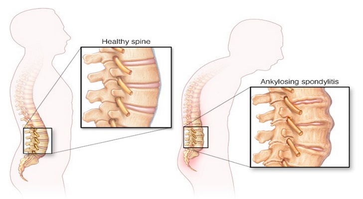 Ankylosing Spondylitis Symptoms and Signs