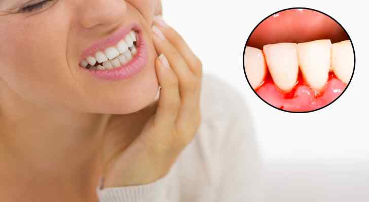 Periodontal Disease Causes, Signs and Symptoms