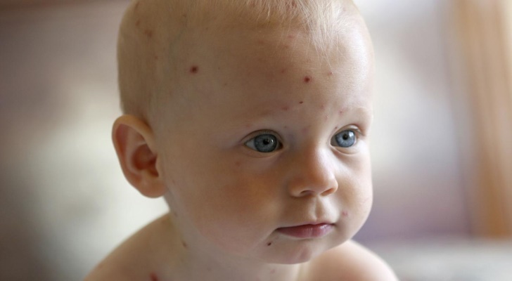 Chickenpox Signs and Symptoms
