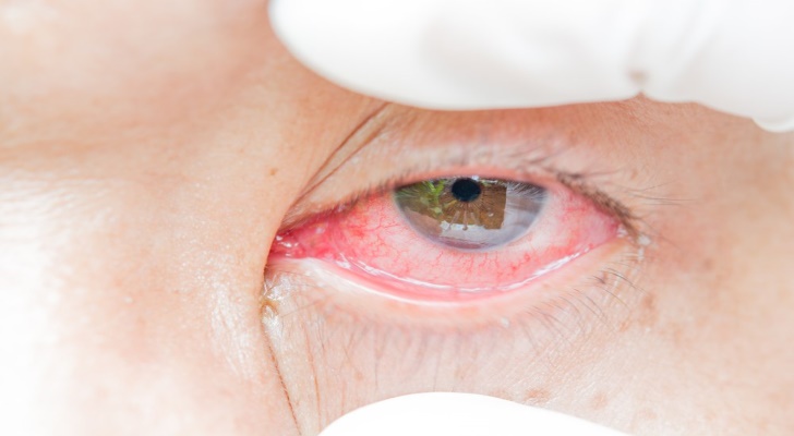 Conjunctivitis Symptoms and Signs