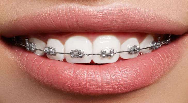 Affordable Dental Braces. How Much Do Braces Cost?