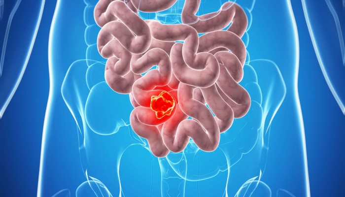 Crohn’s Disease Symptoms, Causes and Signs