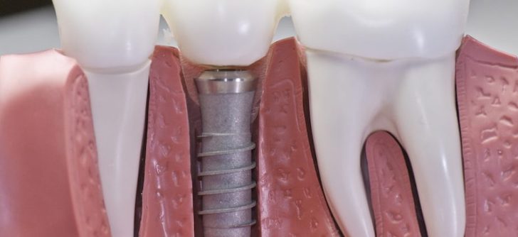 Dental Implants Procedure, Cost and Types