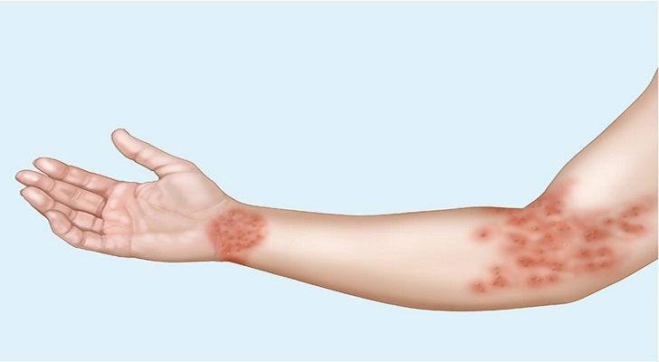 Eczema Symptoms and Causes (Atopic Dermatitis)