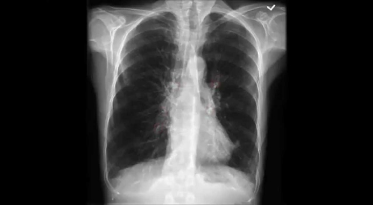 Emphysema Symptoms, Causes and Diagnosis