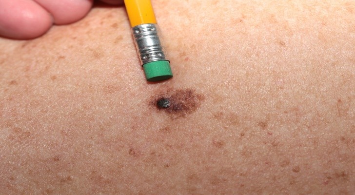 Melanoma, Skin Cancer Symptoms and Signs