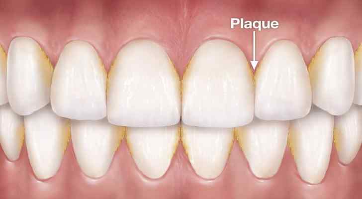 Periodontal Disease Causes, Signs and Symptoms