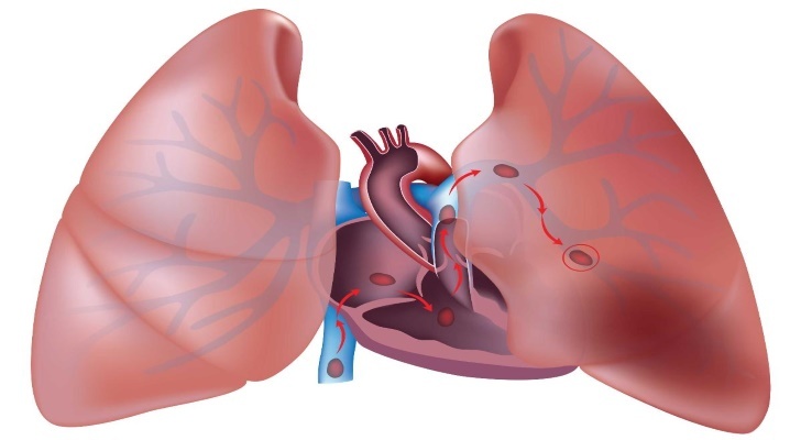 Pulmonary Embolism Symptoms, Signs and Causes