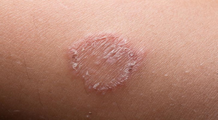 Ringworm Symptoms and Signs