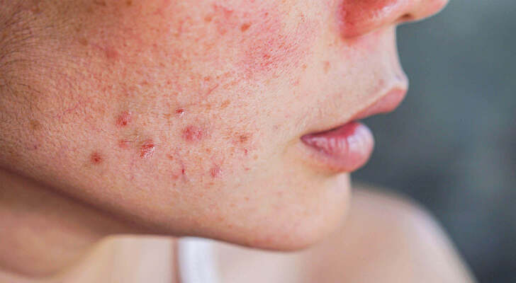 Rosacea Symptoms and Signs