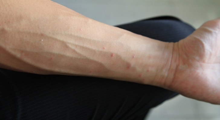 Scabies Symptoms, Causes and Treatments