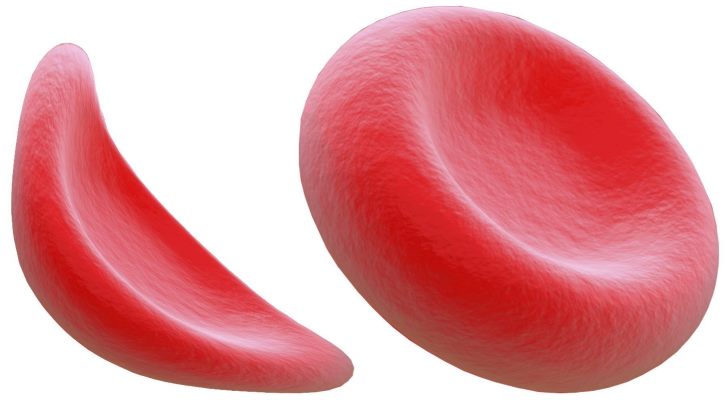 What Sickle-Cell Anemia Symptoms, Signs and Causes