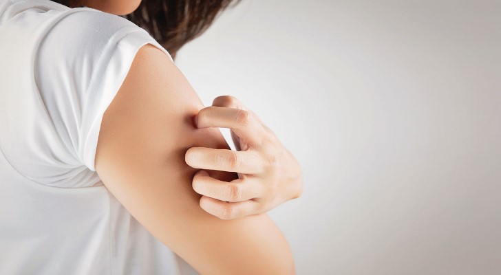 Urticaria (Hives) Types, Symptoms and Causes