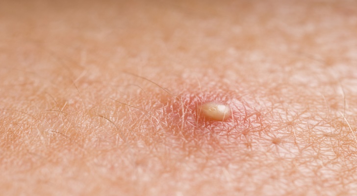 Staph Infection Symptoms and Causes