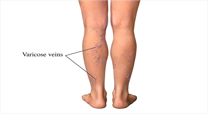 Varicose Veins Symptoms, Causes and Diagnostics