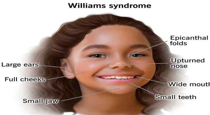 Williams Syndrome Symptoms, Diagnosis and Treatment